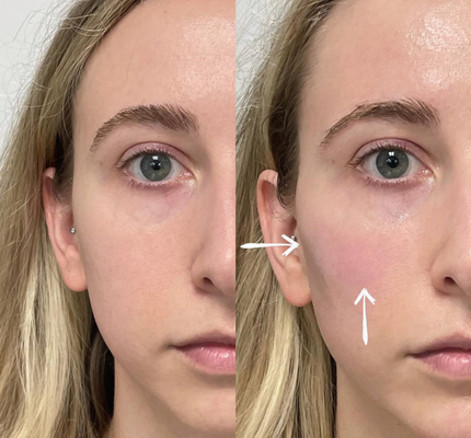 Skinject Deep Hyaluronic Acid Dermal 2ml Chất làm đầy môi có thể tiêm