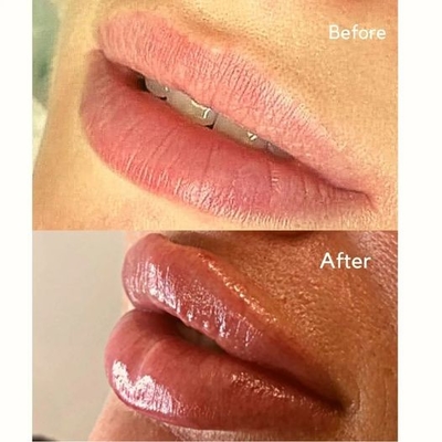 Tiêm Filler Tiêm Juvederms Ultra 3 HA Dermal Filler cho vùng môi