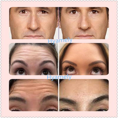 Thổ Nhĩ Kỳ Allergan  100 IU Độc tố Botulinum Kéo dài