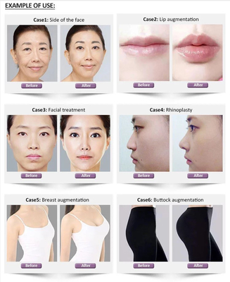 Revolax Fine Deep Sub-Q Hyaluronic Acid Chất làm đầy da liên kết chéo 1.1ml