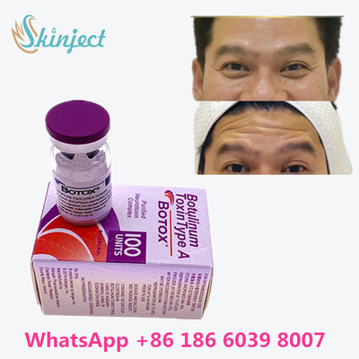 Botulinum Toxin Chống lão hóa Allergan  Trực tuyến Mua Chống nhăn