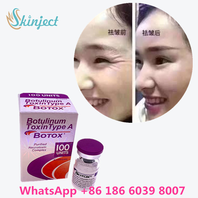 Botulinum Toxin  Xóa nếp nhăn 100u Allergan 100 đơn vị để tiêm nâng cơ mặt