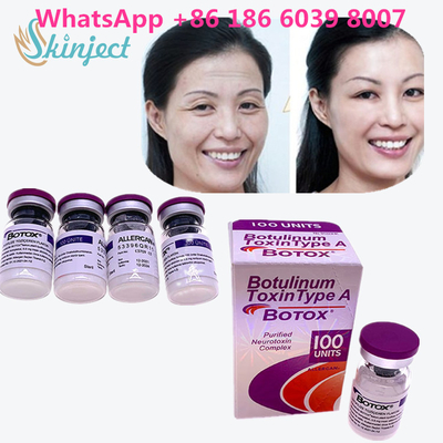 Botulinum Toxin  Xóa nếp nhăn 100u Allergan 100 đơn vị để tiêm nâng cơ mặt