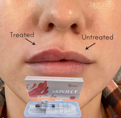 Thuốc tiêm Deep Hyaluronic Acid Dermal 2ml Lip Filler Má Chin Nasolabial Fold