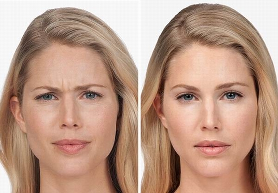 100 Iu Sản phẩm chống nhăn Hàn Quốc Botulinum Toxin  Type A
