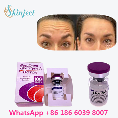 100% Botulinum Toxin  100u gốc để xóa nếp nhăn