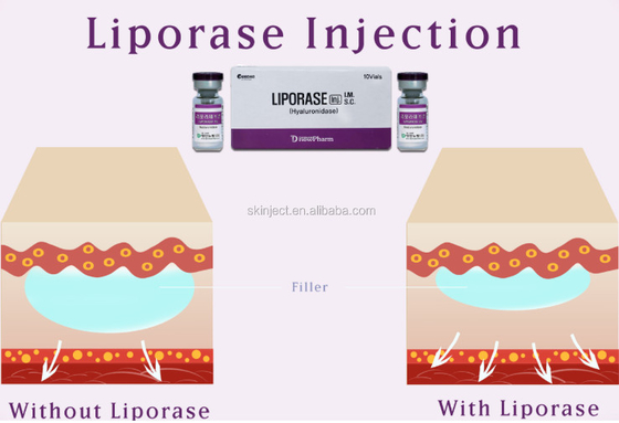 10 Vias Liporase Hyaluronidase để chất làm đầy da hòa tan
