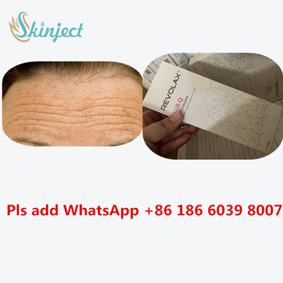 Chất làm đầy da dạng tiêm Revolax 24 Mg / Ml HA Hyaluronic Acid Tiêm
