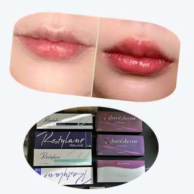 2 * 1ml / Box Cross Linked Dermal Filler cho tăng môi