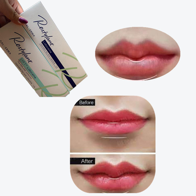 2 * 1ml / Box Cross Linked Dermal Filler cho tăng môi