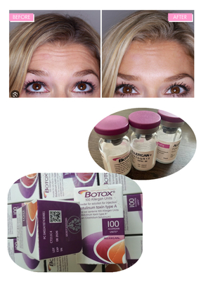 Chất độc Botulinum Allergan 100IU 150iu Tiêm  ' Na