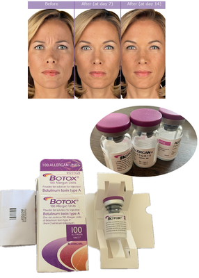 chống nếp nhăn Botulinum Toxin Allergan 100IU 150iu ' Na