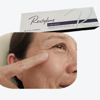 Ác acid hyaluronic HA liên kết chéo để làm đầy khuôn mặt