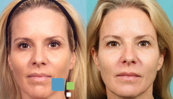 3D PLLA Injection Filler để tái tạo collagen khuôn mặt