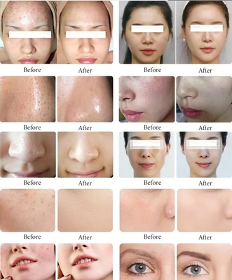 Black Pearl Skin Eye Management Hydrogen Oxy Bubble Skin Cleansing Moisturizing Beauty Machine (Máy làm đẹp dưỡng ẩm)