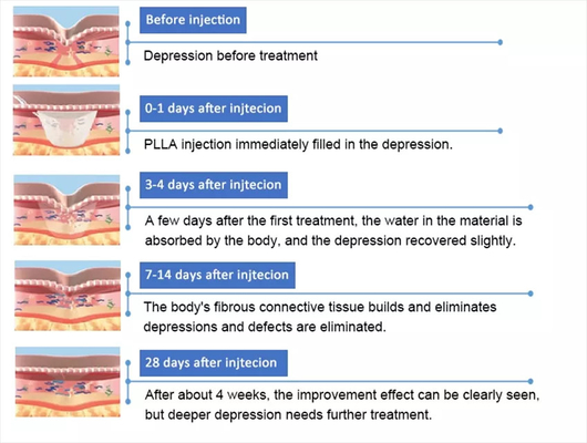 PLLA Poly- L- lactic Acid Face Injection 10 chai 150mg