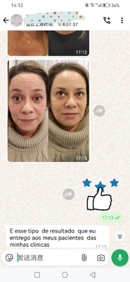 Mua 1 chai Dysport 500iu  Toxins Injection For Face