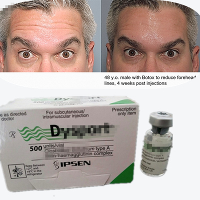 Botulinum Toxin Dysport Bột chống nếp nhăn Bột đông khô cho các đường nhăn