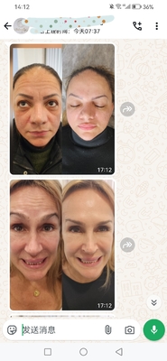 Cosmetic Dysport 500 đơn vị Botulinum Toxin 500 IU bột cho tiêm