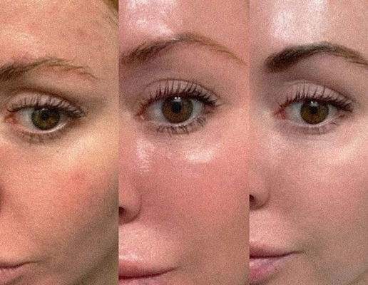 Phong trào Collagen Profhilo Tiêm chất lấp da 5 điểm