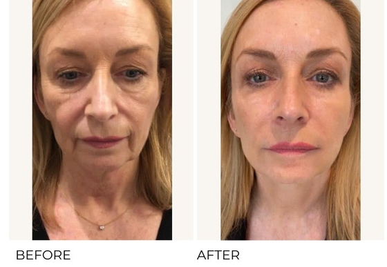 Chống lão hóa và loại bỏ nếp nhăn Profhilo H L 2ml axit hyaluronic với nồng độ 32mg/ml Ha