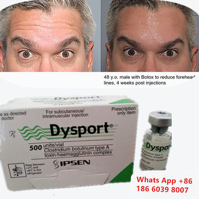 Botulinum Toxin A Dysport Botox Tiêm cho các đường môi