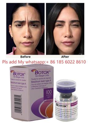 Tiêm Botulinum Toxin Allergan Botox 100IU - Giảm dấu hiệu lão hóa với Allergan