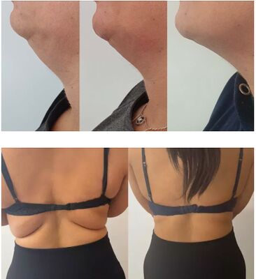 Chất xả mỡ trong chai chanh dung dịch lipolytic