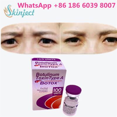 Botulinum Toxin ALLERGAN BOTOX Thời gian từ 4 đến 6 tháng 100 đơn vị loại A