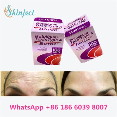 Allergan Botox Botulinum Toxin loại A 100 đơn vị để loại bỏ nếp nhăn với thời gian 4 ~ 6 tháng