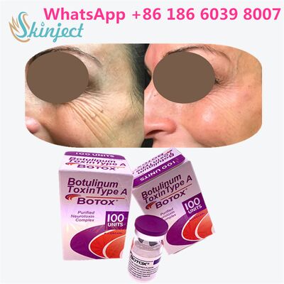 Allergan Botox Botulinum Toxin loại A 100 đơn vị để loại bỏ nếp nhăn với thời gian 4 ~ 6 tháng