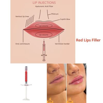 Thời gian phục hồi tức thì Revolax Deep Filler Tuyệt vời cho việc làm đầy môi mang lại kết quả tự nhiên và thời gian nghỉ dưỡng tối thiểu