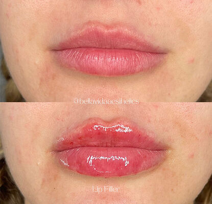 Chất làm đầy da dạng gel tiêm có hạn sử dụng 2 năm, được thiết kế để giảm nếp nhăn, tạo đường nét khuôn mặt và trẻ hóa da