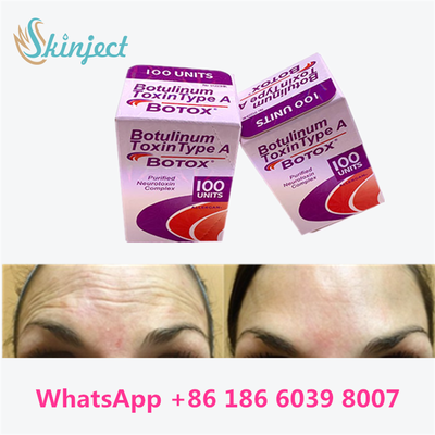 Botulinum Toxin Allergan BOTOX Mỹ phẩm tiêm 100 đơn vị cho dòng Glabellar