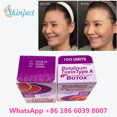Botulinum Toxin Allergan BOTOX Mỹ phẩm tiêm 100 đơn vị cho dòng Glabellar
