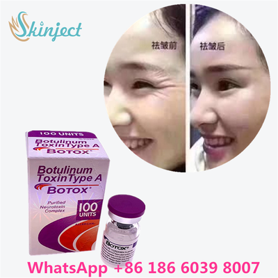 Botulinum Toxin Allergan Botox Bột Trắng Điều trị hiệu quả nếp nhăn trên khuôn mặt và thư giãn cơ trong y tế