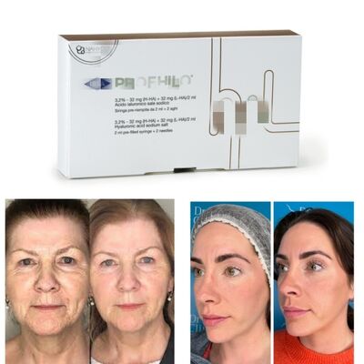 Điều trị Profhilo Tăng cường độ ẩm cho da Axit Hyaluronic & Tái tạo sinh học