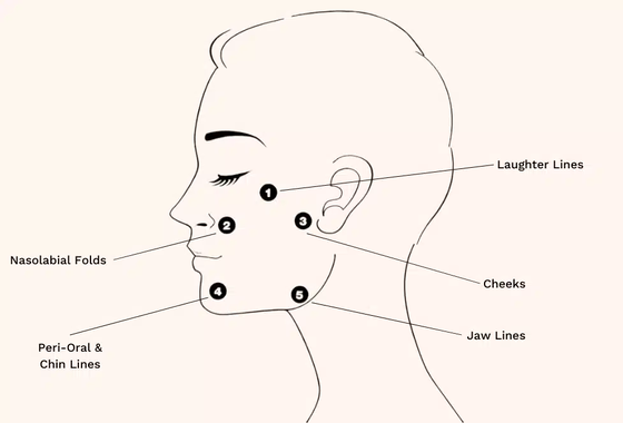 Điều trị Profhilo Tăng cường độ ẩm cho da Axit Hyaluronic & Tái tạo sinh học