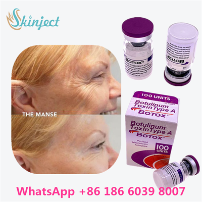 Botulinum Toxin BOTOX Cosmetic 100 Đơn vị Allergan OnabotulinumtoxinA cho nếp nhăn trên khuôn mặt