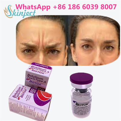 Botulinum Toxin BOTOX Cosmetic 100 Đơn vị Allergan OnabotulinumtoxinA cho nếp nhăn trên khuôn mặt