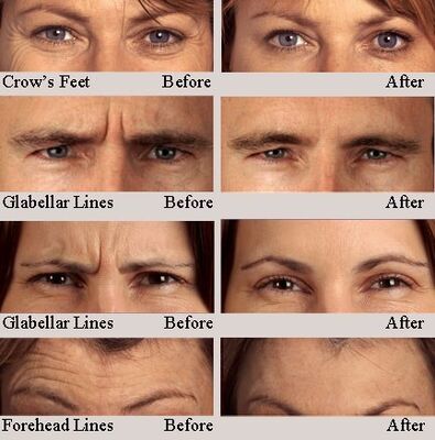 Hyamely Botulinum Toxin Loại A Tiêm