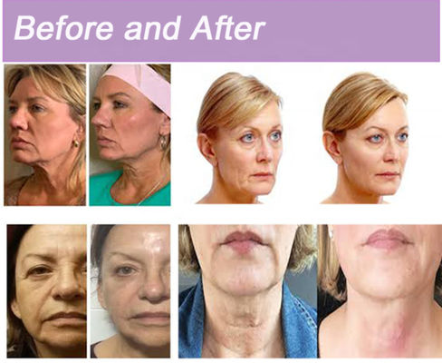 Chủ đề Collagen PDO chống lão hóa Polidioxanona Sutura Face Lifting