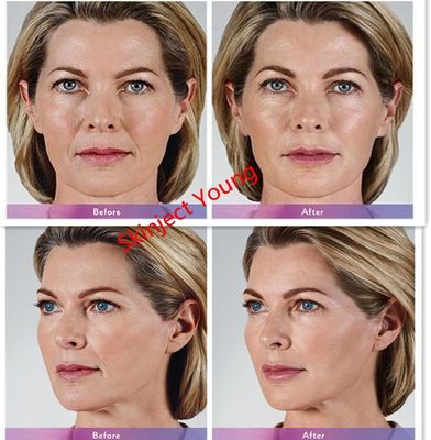 Juvederm Voluma 2x1ml Chất làm đầy axit hyaluronic có thể tiêm