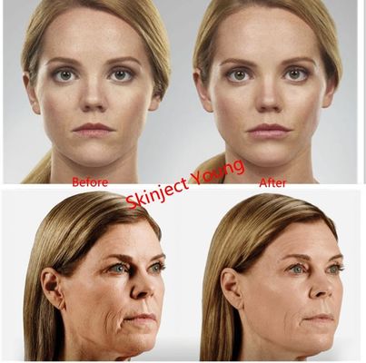 Juvederm Voluma 2x1ml Chất làm đầy axit hyaluronic có thể tiêm