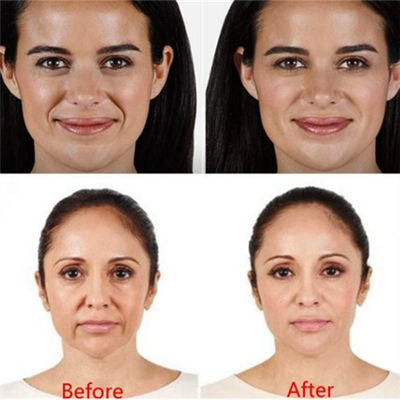 Juvaderm Voluma Hyaluronic Acid Pen Filler cho nếp nhăn vùng trán