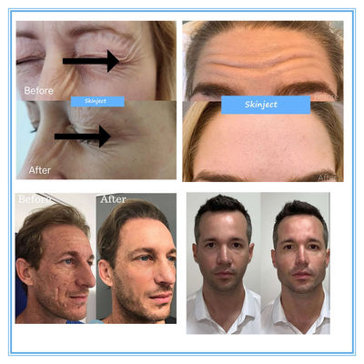 Tiêm xóa nếp nhăn Hyamely Botax 100 đơn vị Botulinum Toxin Beauty