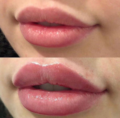 Môi Nga Juvederm Ultra 3 với chất làm đầy da liên kết chéo Lidocain