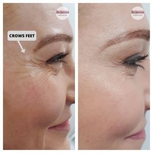 2,5ml muối tiêm Botulinum Toxin chống lão hóa