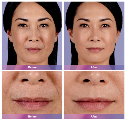 Juvederm Dermal Filler Lip Injection Ultra 4 để làm nở môi