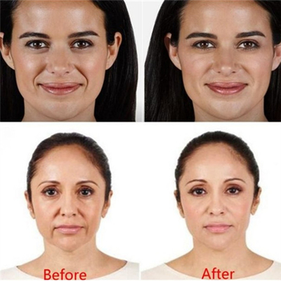 Y tế Sodium Hyaluronate Gel Tiêm HA Dermal Filler Môi Juvederm Voluma